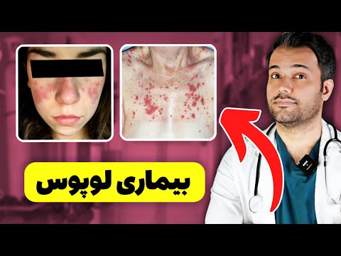 علت تب و التهاب شدید این بیمار مشخص شد 10 علامت بیماری لوپوس که باید بدونید
