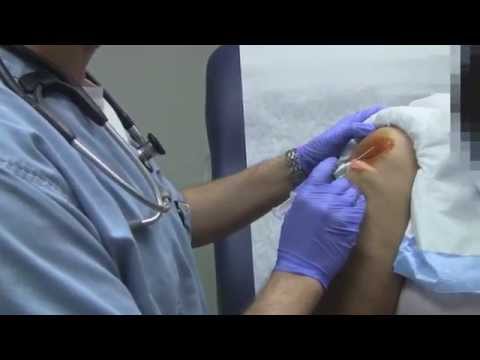 Video: Sådan behandles subakromial bursitis