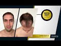 Hair transplant turkey before   after  8 months results
