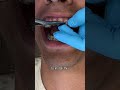 Don’t do this with braces 😭 #braces