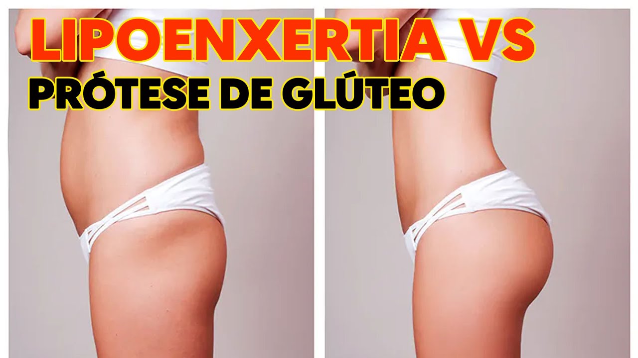 Qual é a melhor técnica para aumentar os glúteos - Cirurgia Plástica