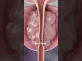 علاج تضخم البروستاتا  و  رسوم متحركة ثلاثية الأبعاد الحالب باطن المسالك البولية
