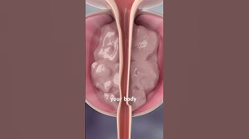 Enlarged Prostate Treatment (Rezum and UroLift) 3D Animation #ureteric #endourology #urologic