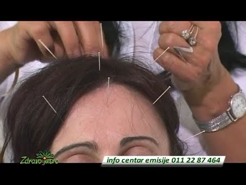 Video: Akupunktura Za Hujšanje: Deluje?