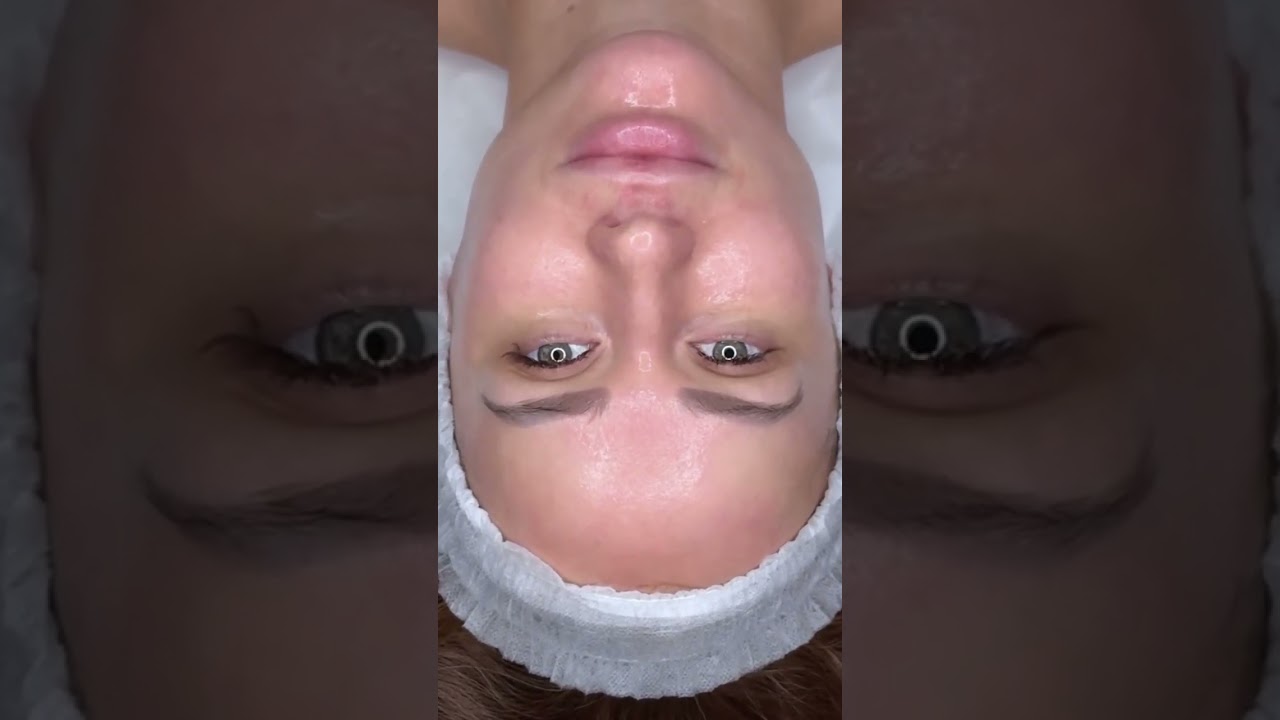 -10 лет этой после химического пилинга - это реальность! #химическийпилинг #пилинг