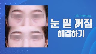 피곤해 보이는 눈, 눈밑꺼짐 때문일까요? │FI PLASTIC SURGERY CLINIC 에프아이 성형외과