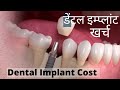 डेंटल इम्प्लांट मैं कितना खर्च, Dental Implant Cost & Price in Delhi, India-  एक दांत लगाने का खर्च