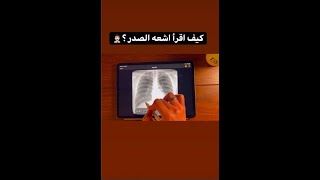 كيف تقرأ اشعه الصدر؟