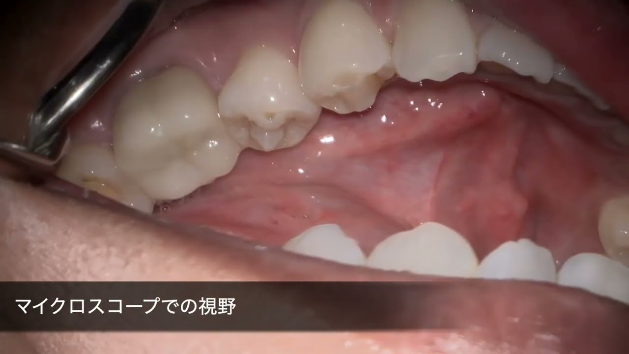 精密治療（マイクロスコープ治療）｜名古屋市中区で100年続く歯医者