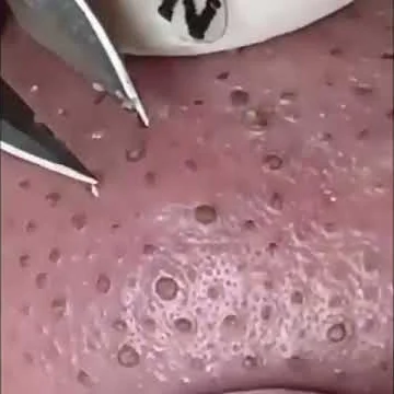 Blackhead Removal #1