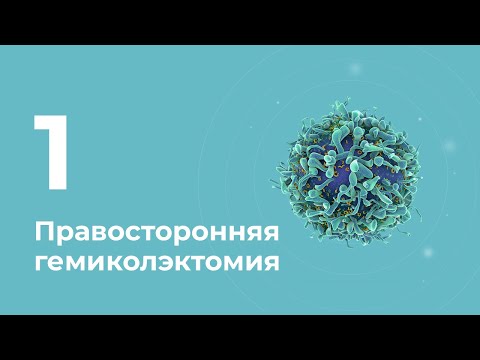 Правосторонняя гемиколэктомия (видео 1)
