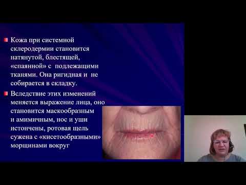 Фак. терапия (Внутренние болезни). Системная склеродермия. Системная красная волчанка