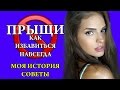 КАК Я ИЗБАВИЛАСЬ ОТ ПРЫЩЕЙ. МОЯ ИСТОРИЯ И СОВЕТЫ