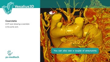 Vesalius3D - Demo Aortic Arch Coarctatio