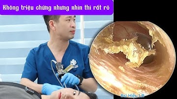 Không triệu chứng nhưng nhìn thì rất rõ 耳かき - ASMR耳掃除 | Bác sĩ Hiệu Long Biên