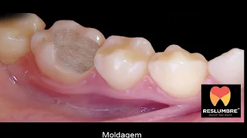 Quanto custa onlay de porcelana?