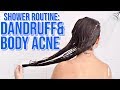 My Shower Routine | Body Acne, Dandruff, Feminine Hygiene