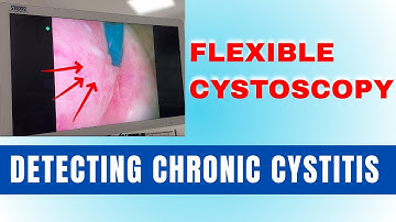 See How We Diagnose Chronic Cystitis Using Flexible Cystoscopy
