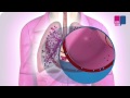 Longontsteking - wat gebeurt er in je longen?