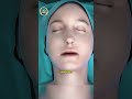 How Jaw Bone Correction Surgery Is Performed 😮 Orthognathic Surgery Explained!