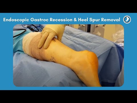 Heel Spur Surgery in New York City | Visual.ly