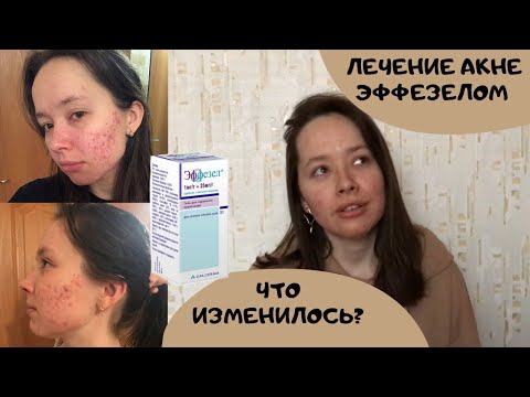 Лечение акне ЭФФЕЗЕЛОМ. Что изменилось за месяц?