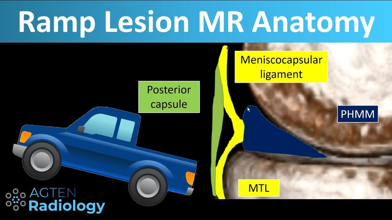 Ramp Lesions on Knee MRI (part 1 Anatomy) YouTube