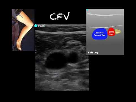 blood clot in leg ultrasound