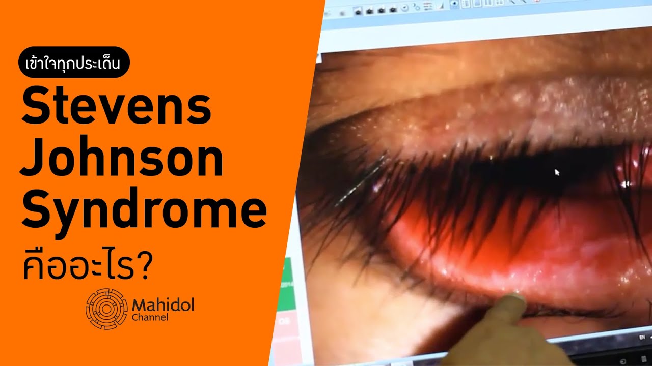 ทำความเข้าใจ 'Stevens Johnson Syndrome' [หาหมอ by Mahidol Channel]