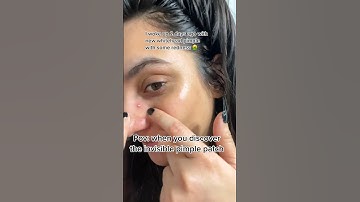 Acne where ?? When you discover the pimple patch that helps clear whitehead in 2 days ❤️ #shorts
