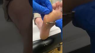 Experience Smooth Strides! Watch Forefoot Callus Removal By An Aussie Podiatrist.