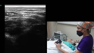 rastreo del Plexo cervical superficial