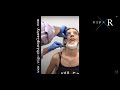 Rhinoplasty &amp; Chin Augmentation | Cast Removal . Ρινοπλαστική - Πωγωνοπλαστική - Πλαστική Πηγουνιού