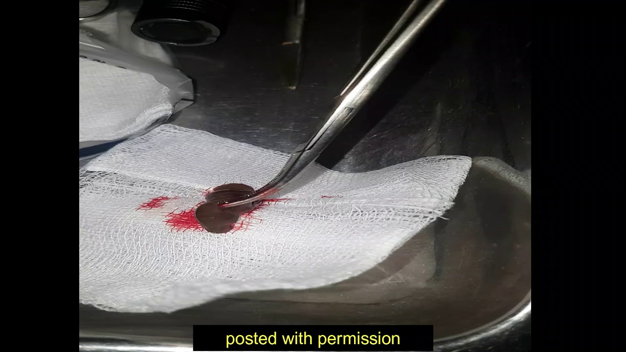 leech removal from throat alive