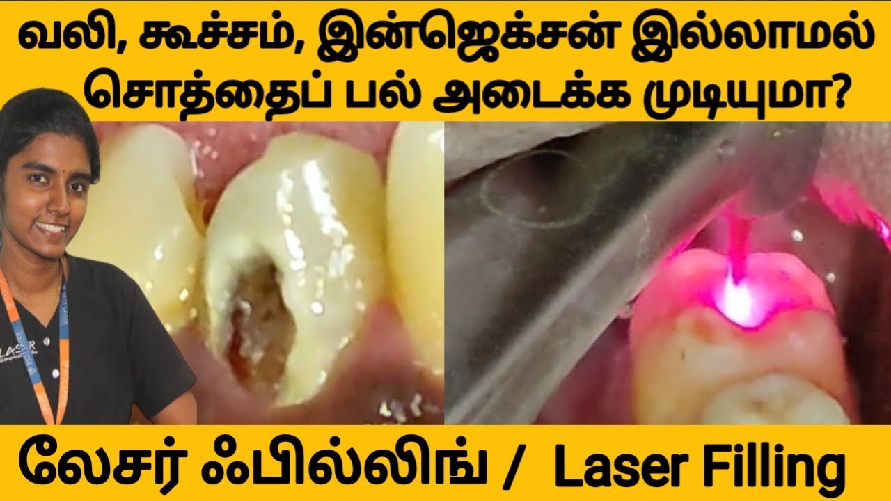 பல் சொத்தைக்கு நவீன லேசர் சிகிச்சை!எப்படி?செலவு? laser for tooth cavity