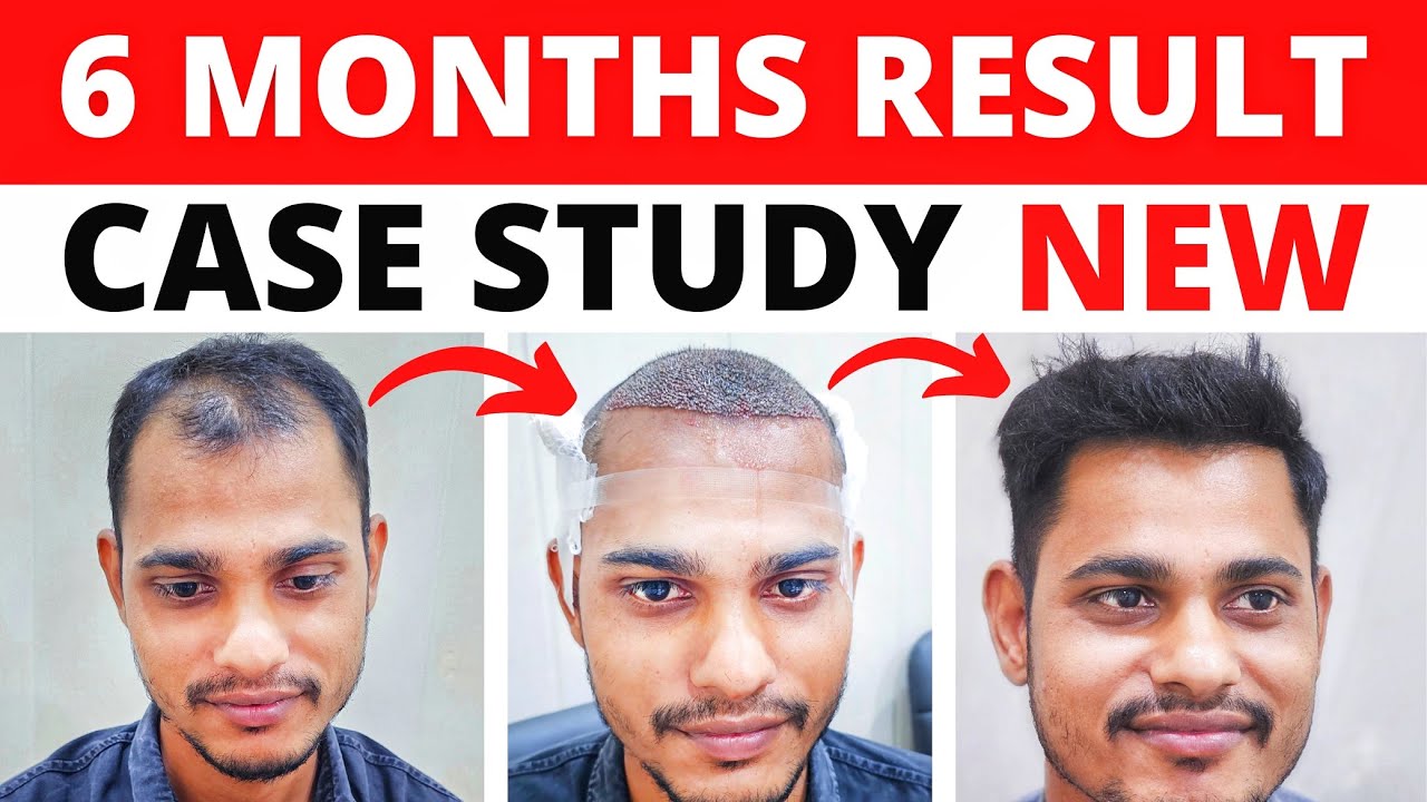 ONLY 3000 GRAFTS Simple FUE Hair Transplant Result | A Full Hair Transplant Journey To Remember 2024
