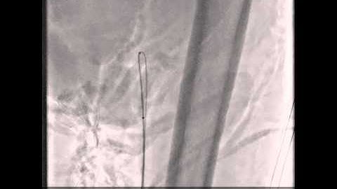 Combined Antegrade and Retrograde Ostial SFA Cross