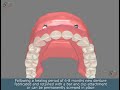 Fixed implant denture option maxillary  smile guru