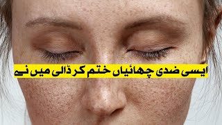 Pigmentation and freckles treatment| Dark spots on face removal treatment