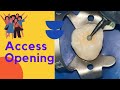 Maxillary Molar Access Opening