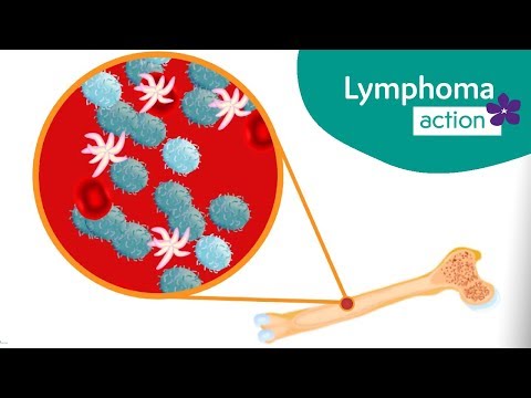 What is Chronic lymphocytic leukaemia (CLL) / Small lymphocytic lymphoma (SLL)?