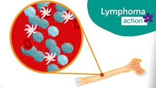 What is Chronic lymphocytic leukaemia (CLL) / Small lymphocytic lymphoma (SLL)?