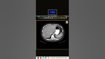 Google Gemini 2.0 Diagnoses Pancreatitis from CT Scan – The Future of Radiology? 🤖🩺
