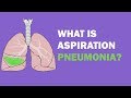 What is aspiration pneumonia?