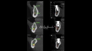 HORIZONTAL AUGMENTATION (GBR) WITH SIMULTANEOUS IMPLANT PLACEMENTS.