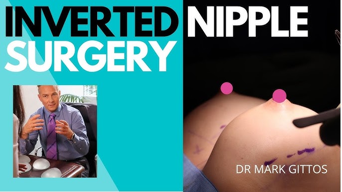 Inverted Nipple Repair - Farber Plastic Surgery