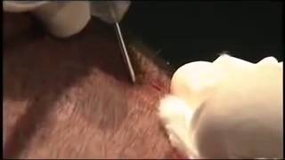 NEO GRAFT Patient Video