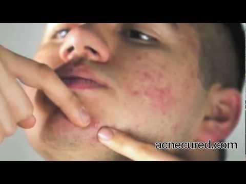 Cystic Acne (Treat the root cause)