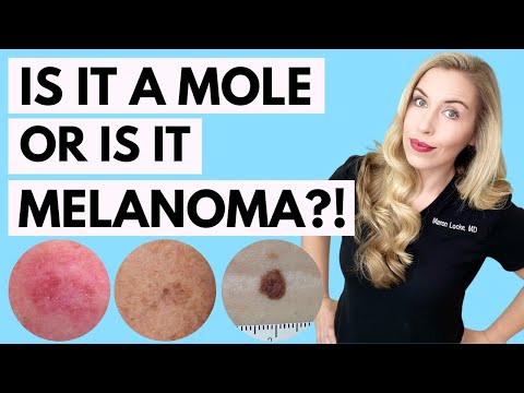 Video: Melanomul înseamnă întotdeauna cancer?