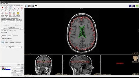 Analyze 15.0 - Segment: Auto Trace
